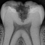 Synthetic sample radiograph crop of lower molar, tooth 36