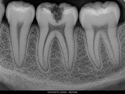 Synthetic sample radiograph of a lower molar with a cavity, before treatment