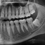 Synthetic sample radiograph crop of quadrant 2