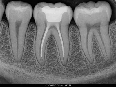 Synthetic sample radiograph of a restored molar after root canal treatment