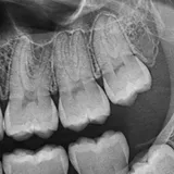 Synthetic sample radiograph crop of the upper molar area, tooth 26